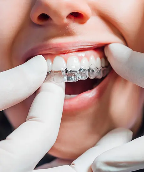 Invisalign